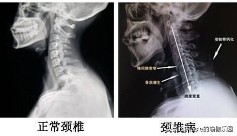 百多福生活|习惯性低头、驼背、向前看，富贵包凸起？5步轻松重塑平滑肩颈