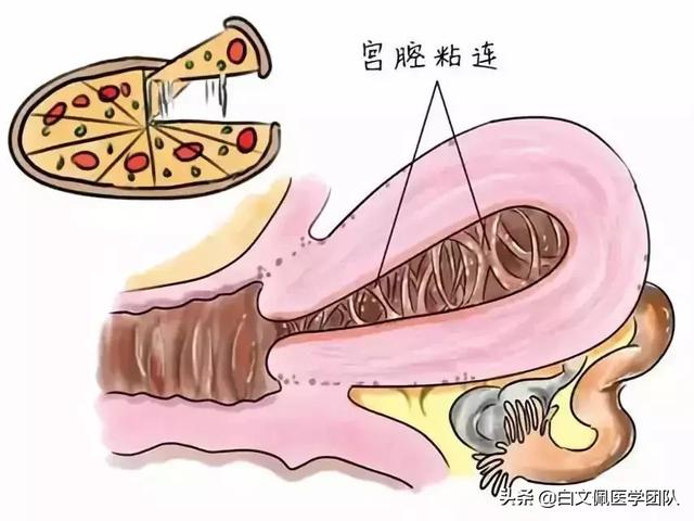 【你的育儿经】备孕路上的拦路虎|打败宫腔粘连，收获好“孕”