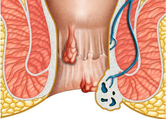 肛门老是潮湿发痒，警惕是癌细胞在“搞事”，及时检查，别大意