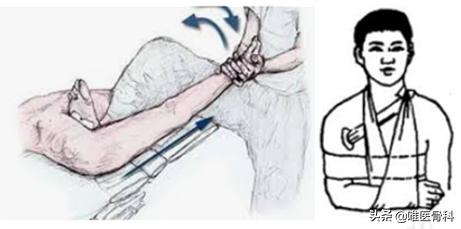 肩膀疼？一个动作，自测是否有肩关节脱位