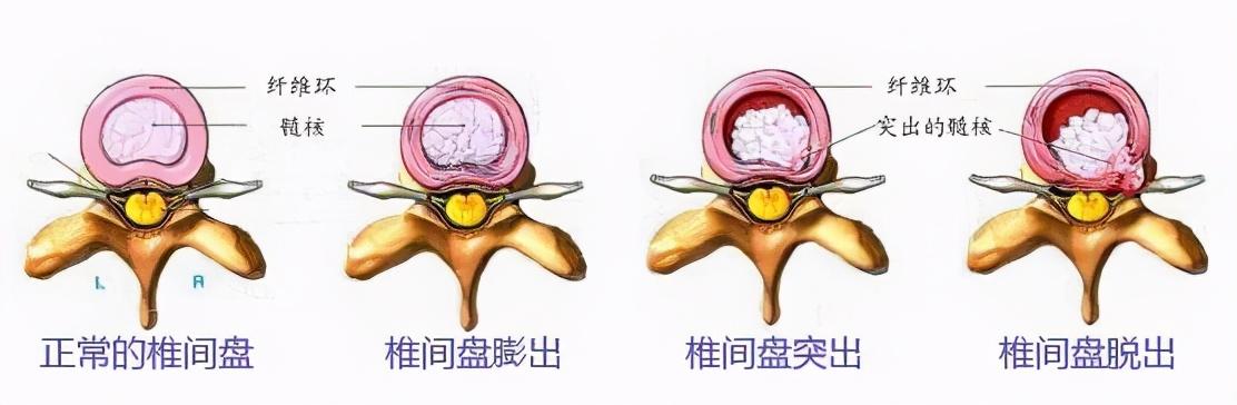 腰椎间盘突出症患者自我康复锻炼的秘方