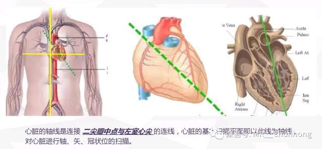 心脏磁共振成像中心肌节段如何划分