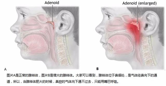 [你的育儿经]孩子睡觉打鼾、用嘴呼吸是睡得香吗？家长要警惕这种病