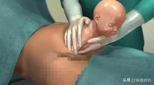 『超级宝妈』剖腹产很容易的，产妇说疼都是矫情，这句话遭受产妇怒斥