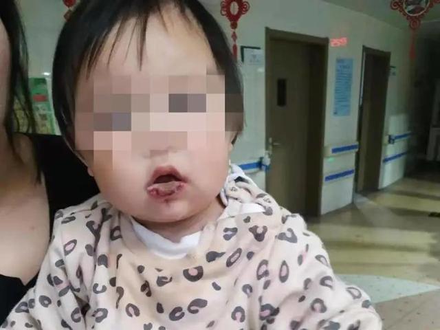 小欣|惊险！1岁宝宝误把它当糖粉吃，嘴唇灼伤，紧急入院……