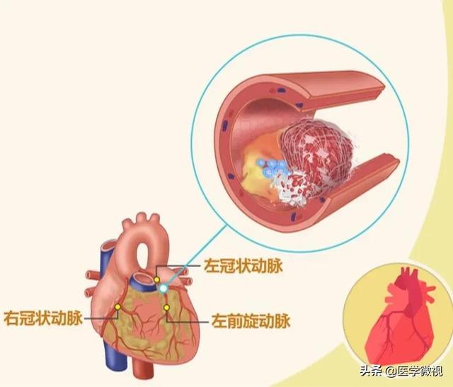 持续性胸痛不缓解？可能是心肌梗死！急救千万记住两个“120”