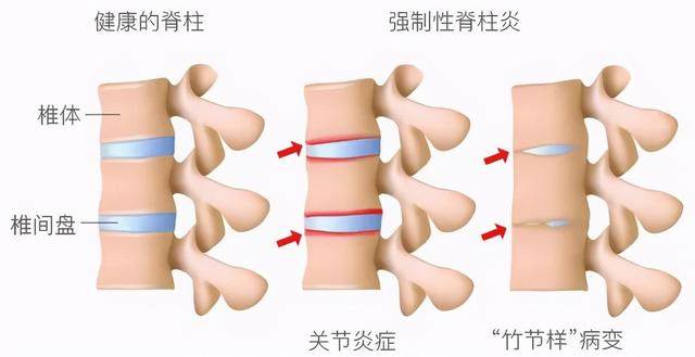 折磨我的腰之前，它先盯上了我的屁股