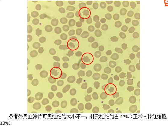 罕见|小伙儿无端“嚼舌”影响进食，专家精准诊断“真相大白”