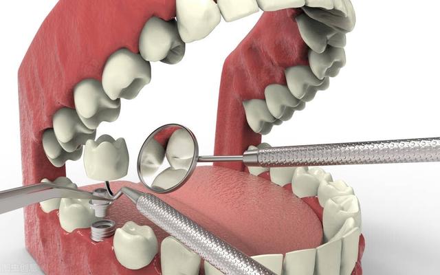 30岁牙齿多颗缺失，为何不采用连冠或ALL-ON-4种植？