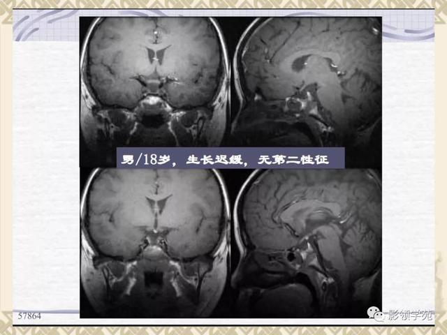 垂体病变的MRI诊断