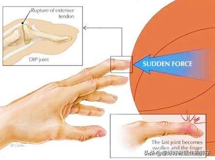 关节囊|打篮球手指受伤养半年还肿痛，拍片骨头没事，应该手术还是康复呢