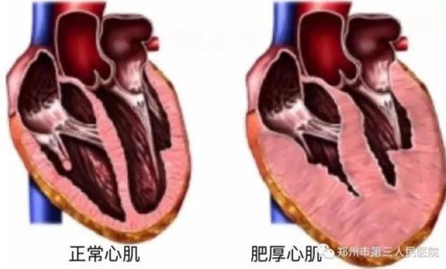 高血压是这样导致心衰、脑卒中、肾衰竭、失明的！