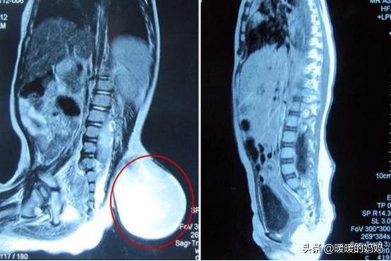 「超级宝妈」6个月宝宝长出“小尾巴”，宝妈悔不当初：早知道孕期不那样做了