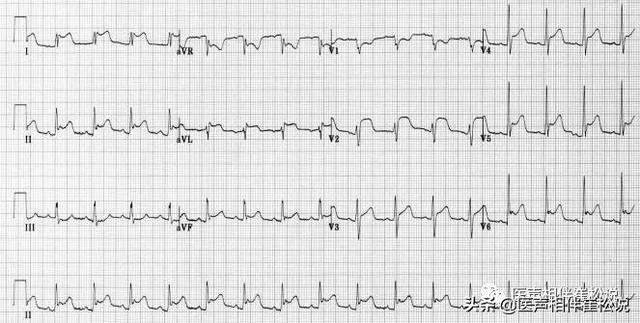 心电图|得了心脏病哪些检查最准确？这份“心脏检查指南”请收好！