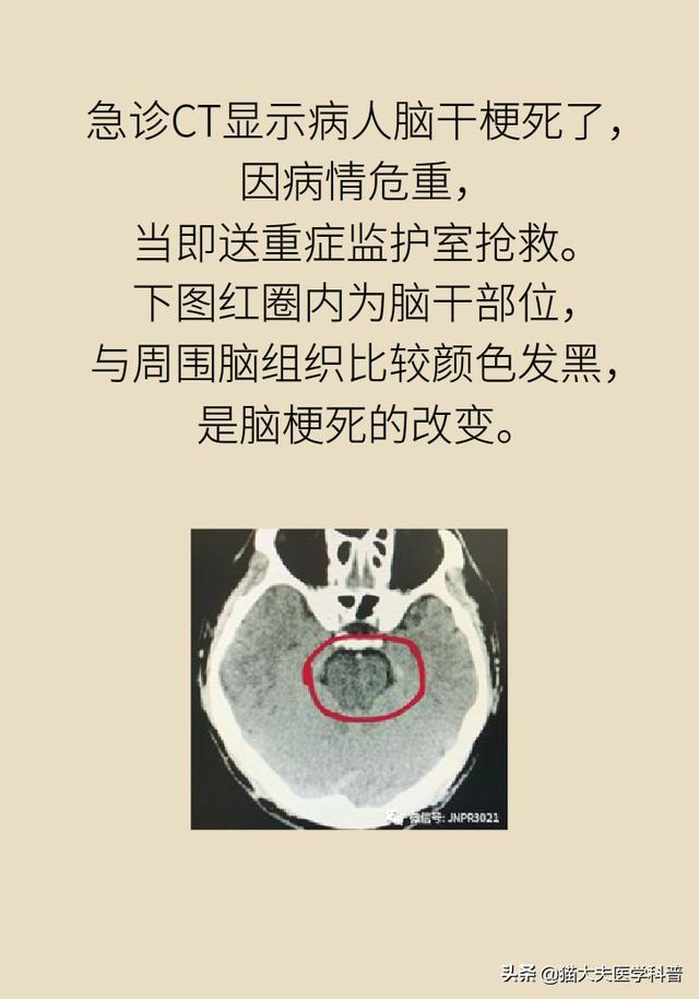 血压、血脂、血糖都正常，30岁男子为啥也得了脑卒中？