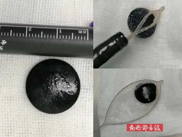 #你的育儿经#海口1岁女孩一吃就吐,拍完片子大吃一惊!家长都应该看看....