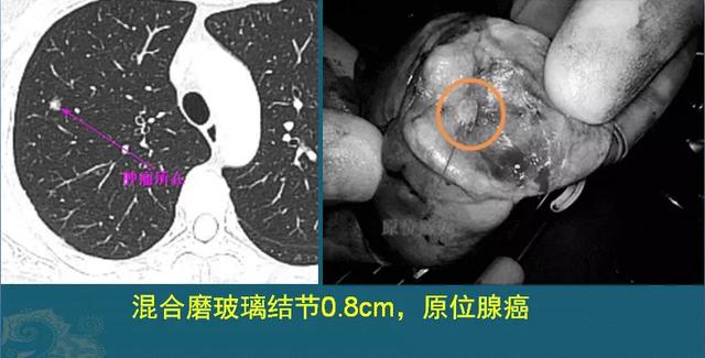 磨玻璃结节就是肺癌吗？