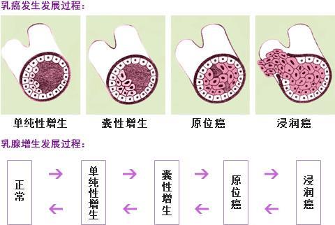 乳腺增生都会癌变吗？这几个关于乳房的知识，你必须掌握