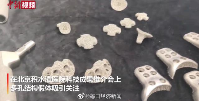 北京一医院推出3D打印关节翻修假体 已造福两百余患者