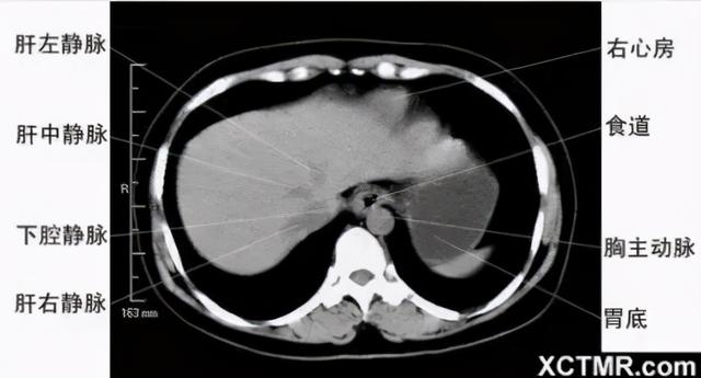影像解剖：胸、腹部、盆腔CT解剖