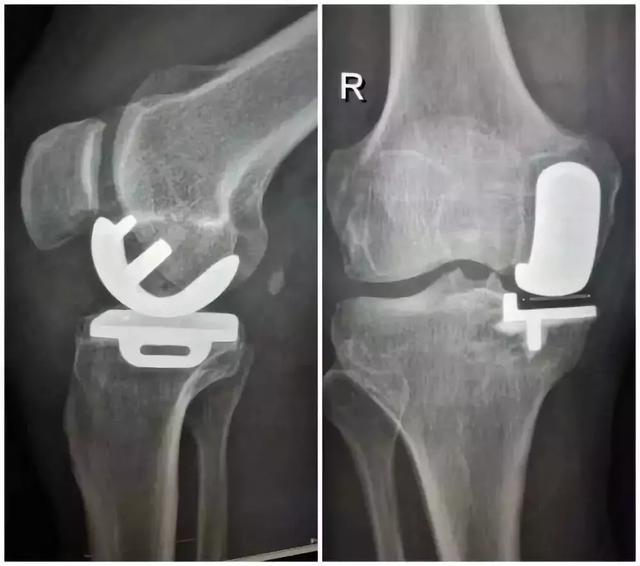 生理年龄|为何大多数老年人都会膝关节疼痛？如何破解？