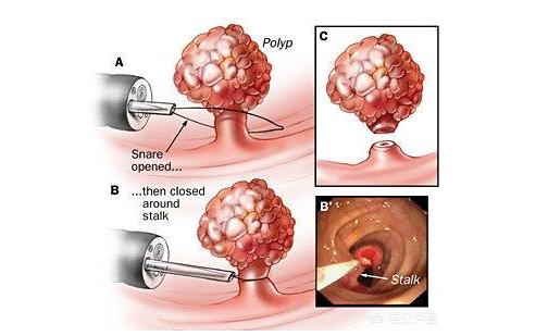 息肉|肠镜发现息肉在非麻醉下能切除吗？为什么有些医院不一次性切除？