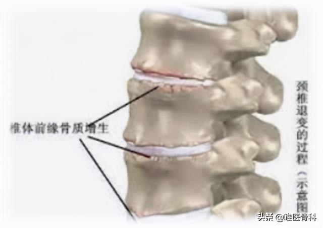 颈肩部酸痛，经常“落枕”？你可能得了「颈椎病」