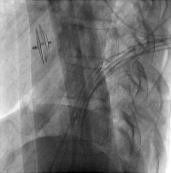 卵圆孔|攻坚克难｜青年脑梗死竟因心脏有个“洞