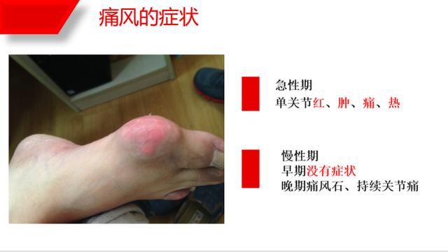 高尿酸和痛风，你想知道的都在这里。