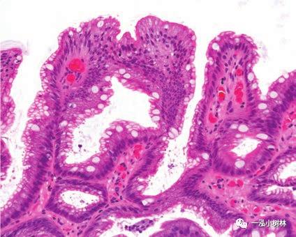 肠上皮化生的放大内镜与病理图像 | 内镜集锦