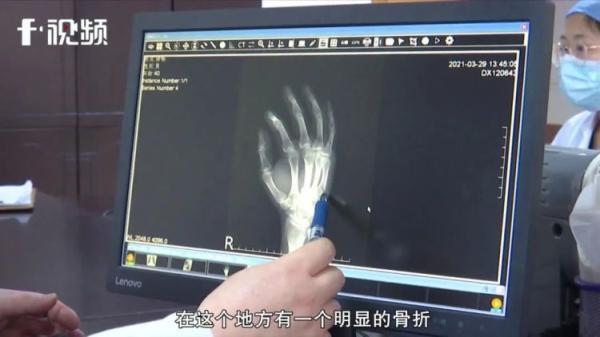 孩子|嫌儿子做作业拖拖拉拉，父亲一怒锤桌子致手掌骨折