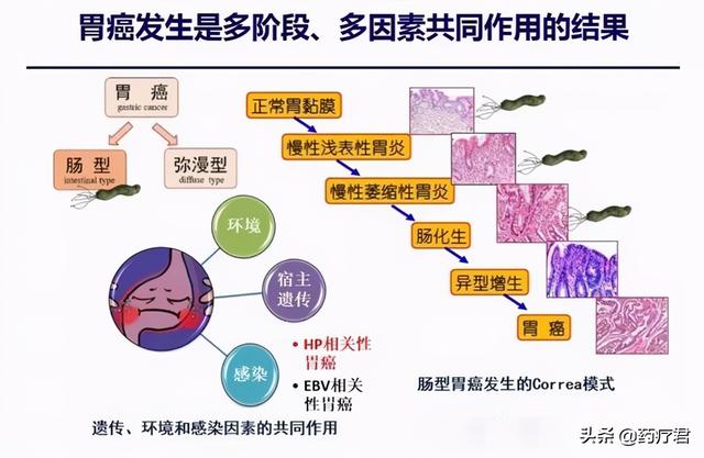 幽门螺旋杆菌，到底是什么？感染了该咋处理？一次都给你讲清楚