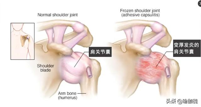神秘的“五十肩”是什么？如何缓解改善效果好？