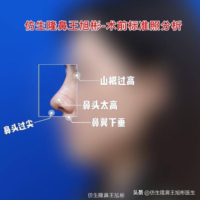 【超级宝妈】鼻尖不好看的宝宝们请看过来