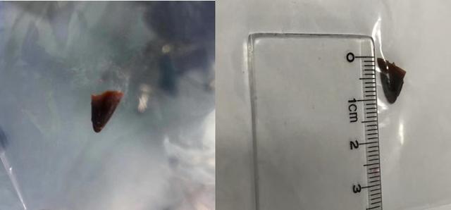 异物|男童肺部发出“吹哨声”情况危急！普陀医生5分钟内化解“头号杀手”