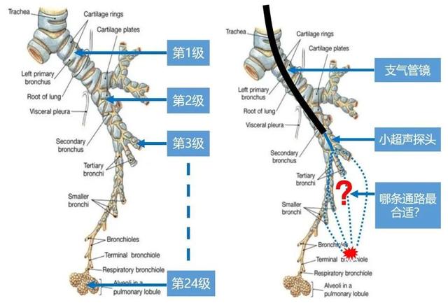 支气管镜|对付磨玻璃结节的新武器，气管里的“导航系统“来了