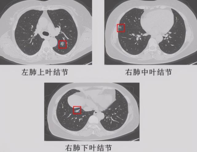 单发结节和多发结节哪个更危险？有好几个结节，要做多少次手术？