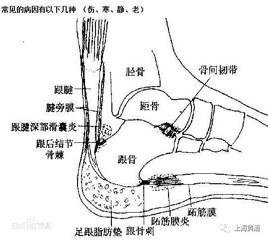 伤科|跟痛知多少？