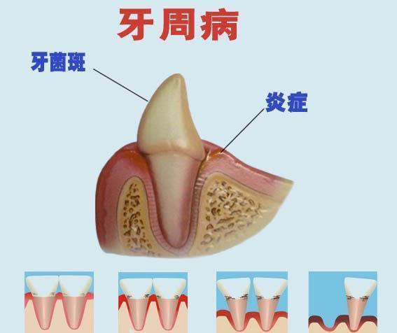 洗牙|每天刷牙，为什么还要定期洗牙