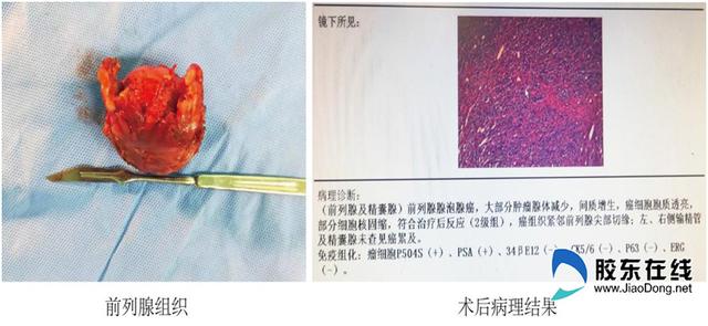 主任|前列腺癌诊疗一体化 滨医烟台附院“医”步到位解病痛