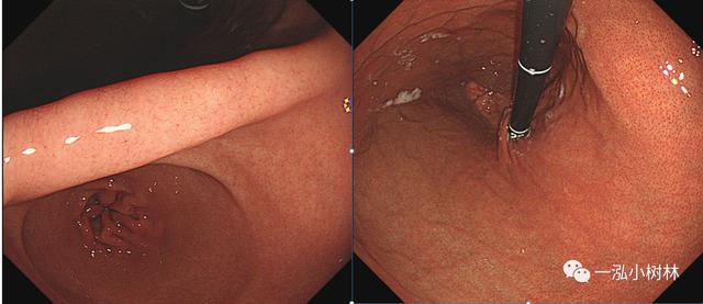 5张图，带你看懂「京都胃炎分类」！| 内镜集锦
