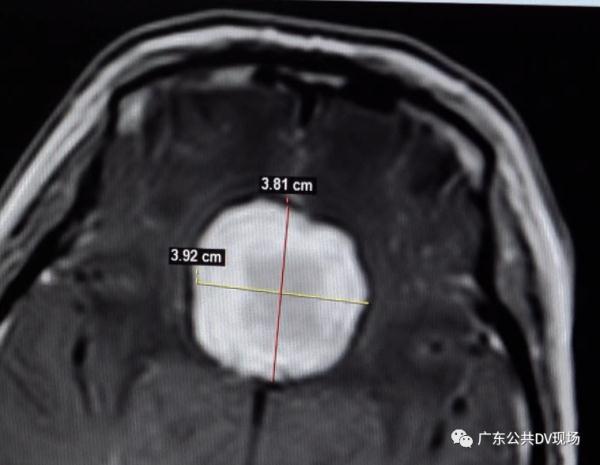 张姨|女子视力模糊误以为上火，没想到出大问题了