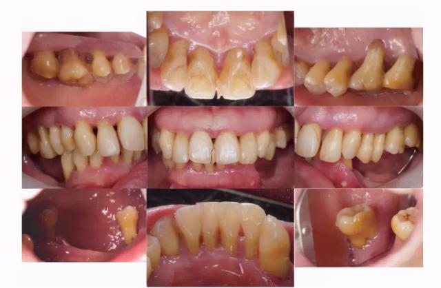 有了这些症状，要小心牙周炎了，小心引发牙疼直接导致牙齿松动