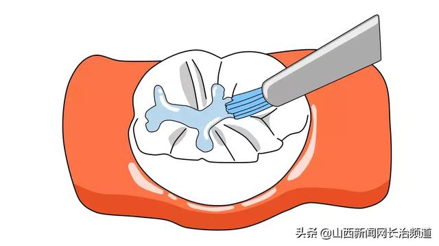 超级宝妈|长兴口腔六一儿童节福利，快带孩子来免费做窝沟封闭吧