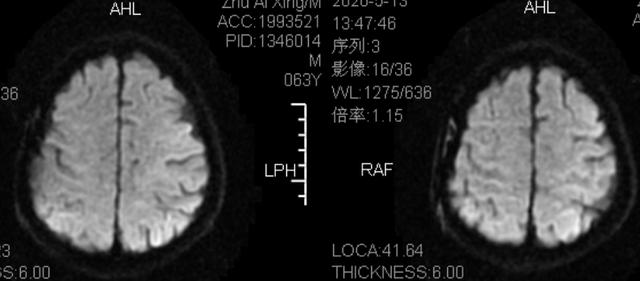 这例 DWI 高信号，不要误诊为脑梗死