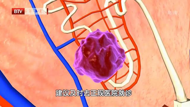 尿酸|尿酸只高一点，也可能得肾癌！少做这三件事，把尿酸降下来