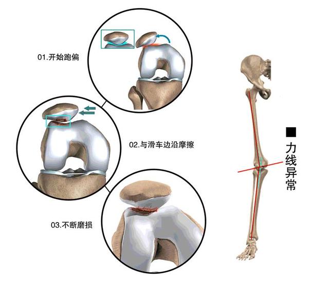 膝关节疼痛、经常打软腿？一种自测方法找原因，四个动作练起来