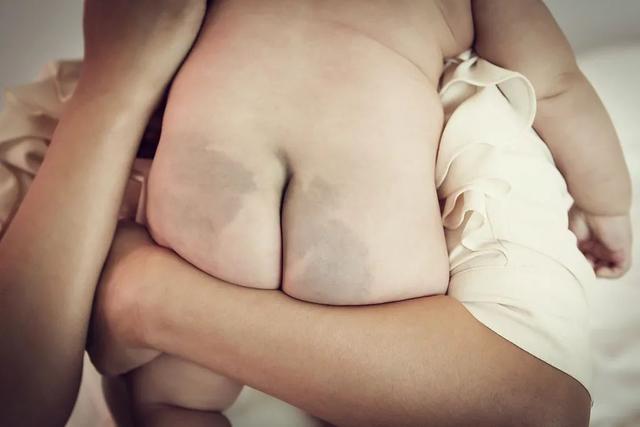 屁股|屁股上“两团黑”是病吗？还能变白吗？终于知道答案了…