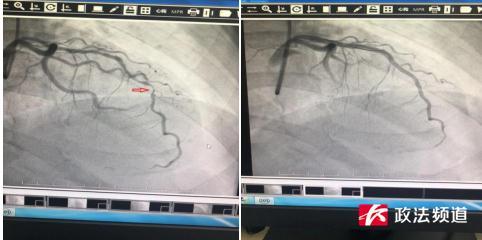 牙痛|长沙6旬老人反复牙痛，入院检查竟与心脏有关