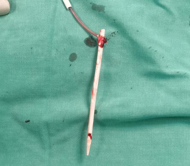 胆大！嫌脖子上的透析管碍事，七旬老太自己剪断了！部分导管“游”到了心脏